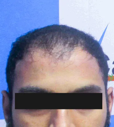 Activated Follicular Transplant Result Before in VCare